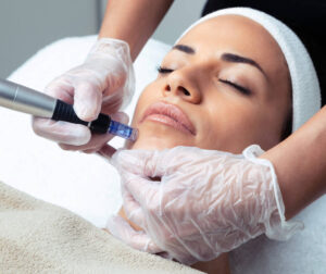 SkinPen-Microneedling Amie Hawks Luxury Skincare